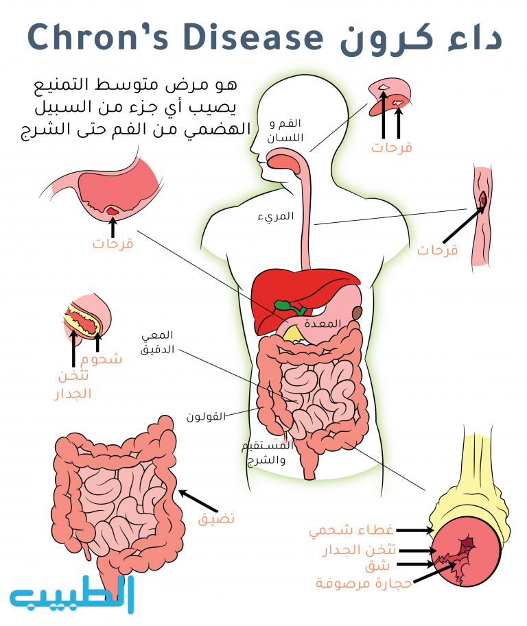 crohn-s-disease