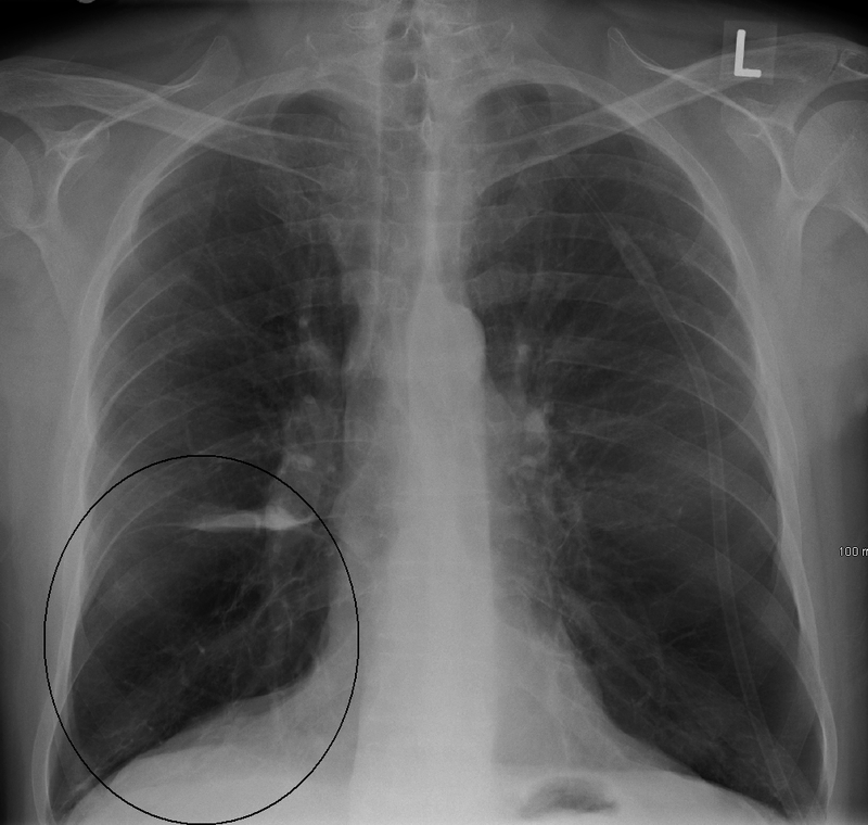 داء الانسداد الرئوي المزمن - صورة صدر بسيطة تظهر منظر الفقاعة مع قلب صغير عند مريض داء الانسداد الرئوي المزمن