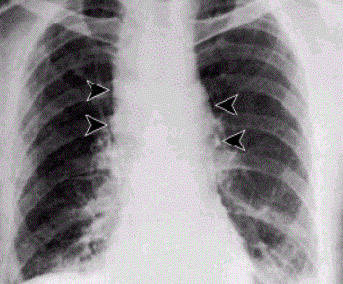 صورة أشعة بسيطة لمريض مصاب بالجمرة الخبيثة